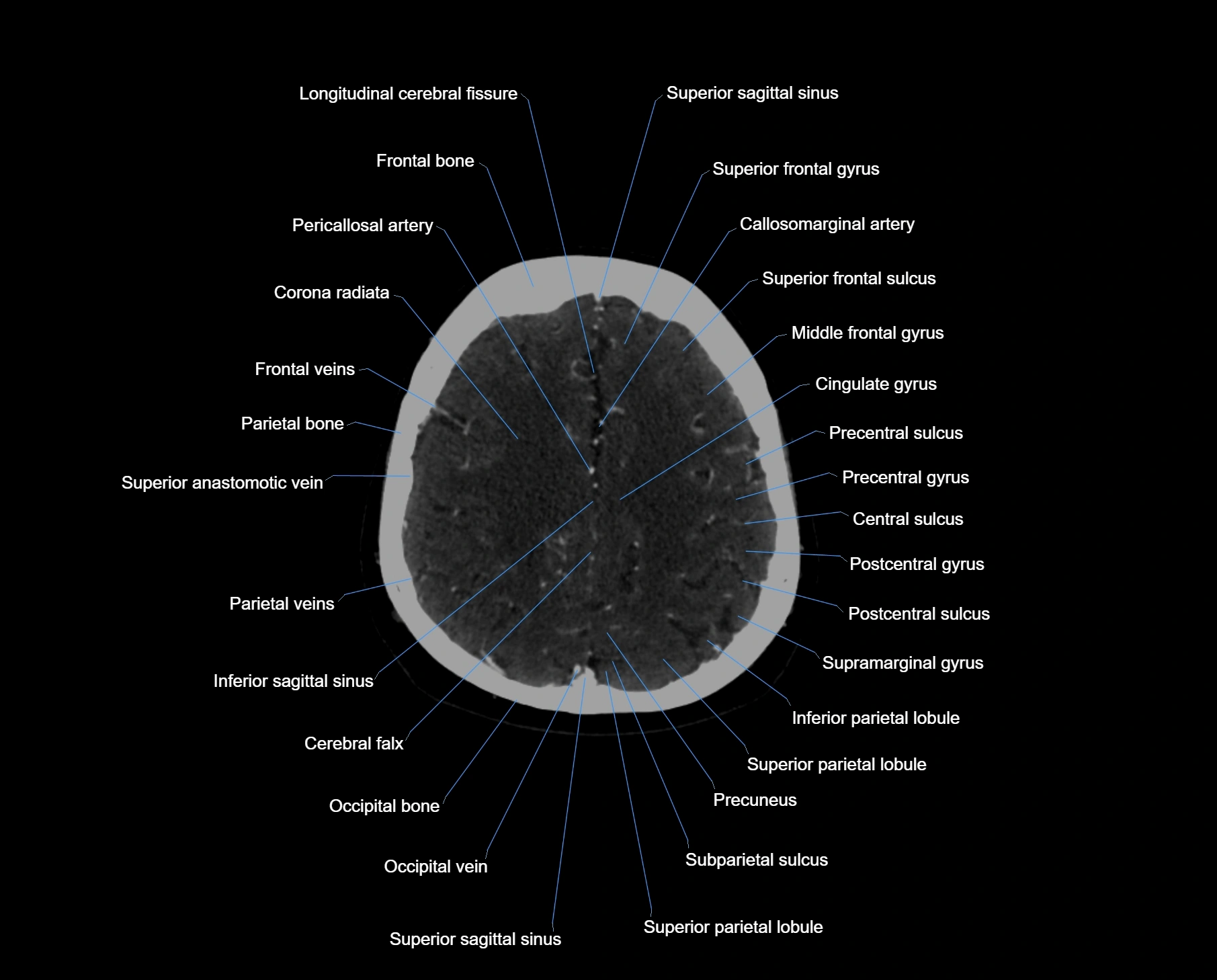 CT scan brain axial labelled cross sectional anatomy image-img-000053.webp